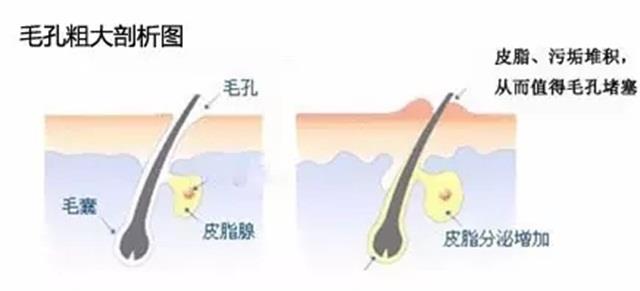 毛孔大脸粗糙用什么方法好（脸上的毛孔粗大怎么改善）-第5张图片-昕阳网